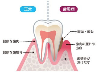 歯周病のイラスト画像