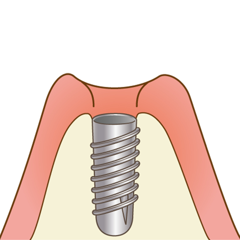 インプラントと骨の結合期間
