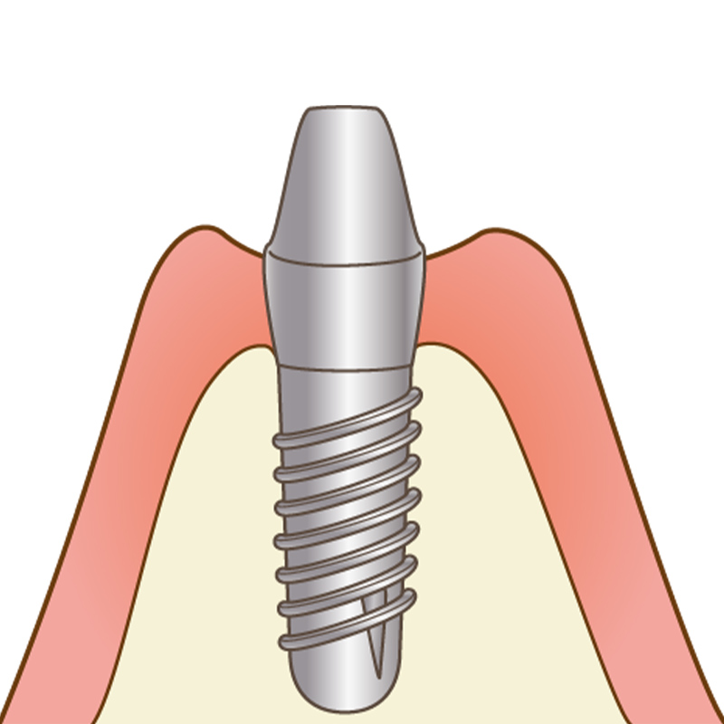 インプラントの土台イメージ